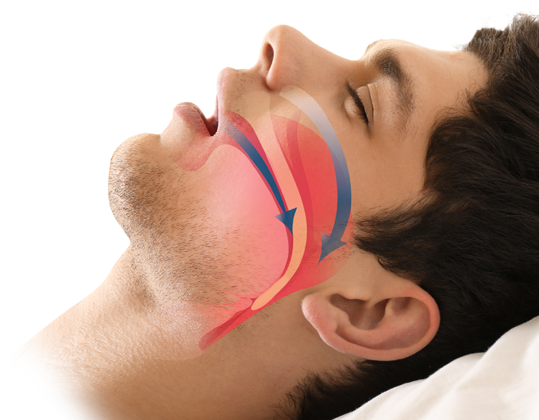Sleep Apnea Treatment  Associated Oral & Maxillofacial Surgeons